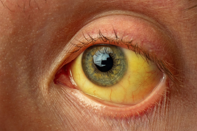 Gelb gefärbtes Auge